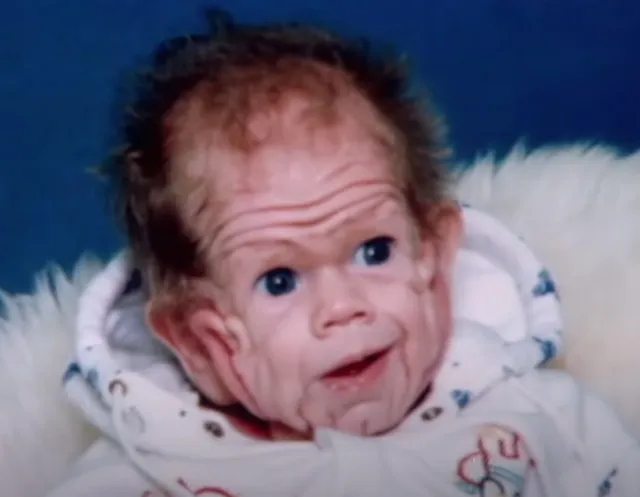 In 1993, This Boy Was Born With Enough Skin For A Five-Year-Old. But Wait Till You See Him Today